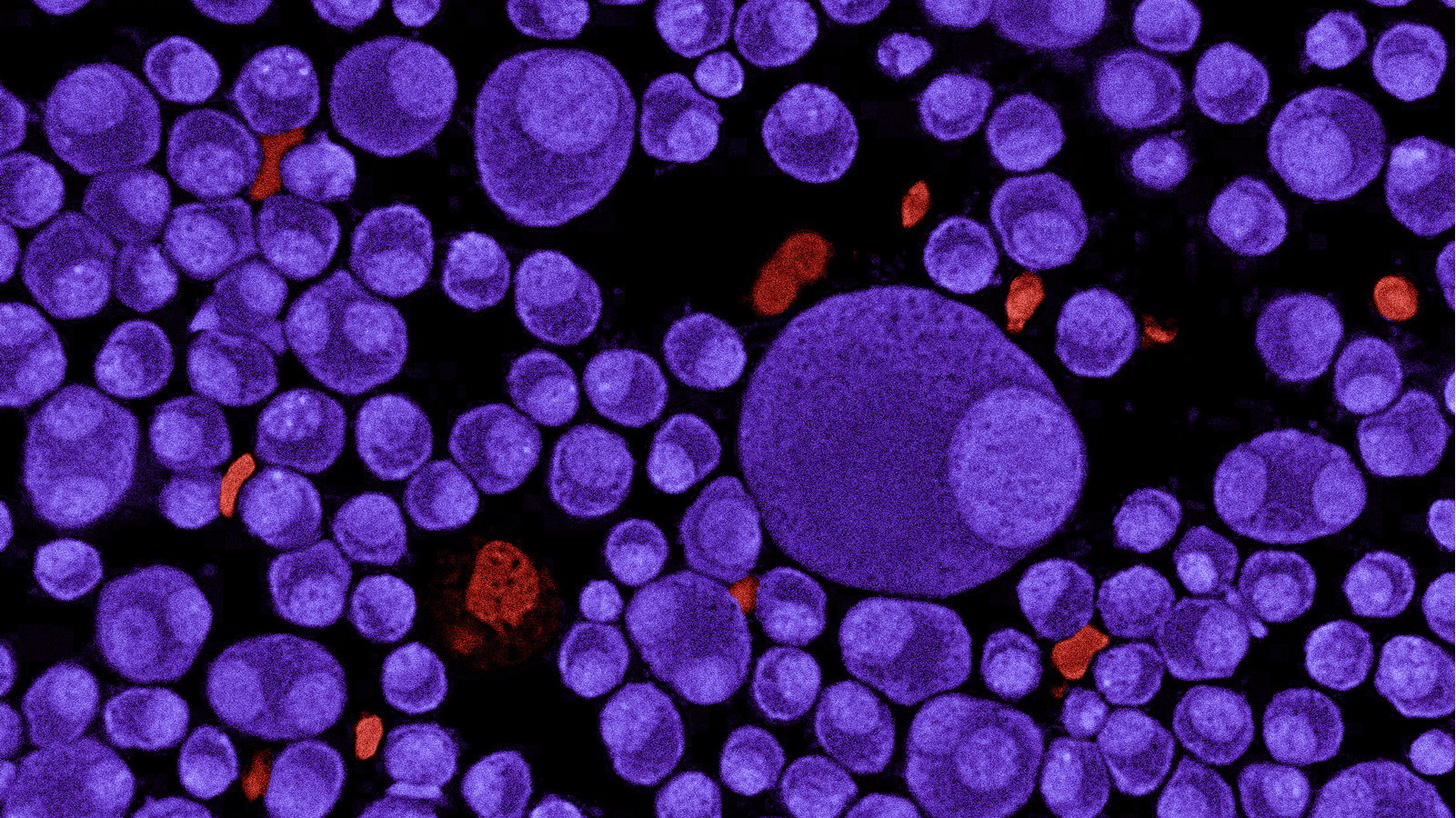 CAR T-cell Therapy for Multiple Myeloma